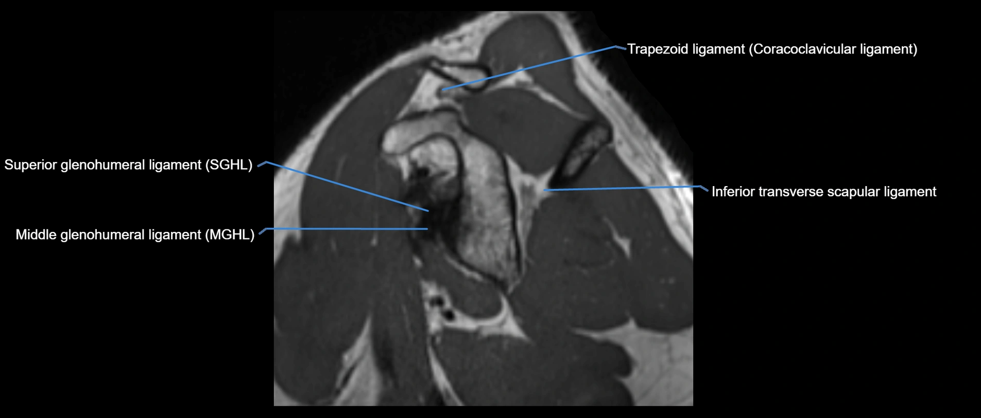 shoulder ligaments sagittal  cross sectional anatomy 3T MRI AI enhanced radiology image -img-00001-00022.webp